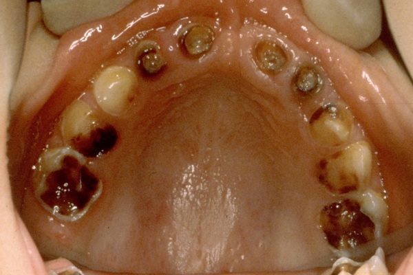 Close up of teeth and gums.