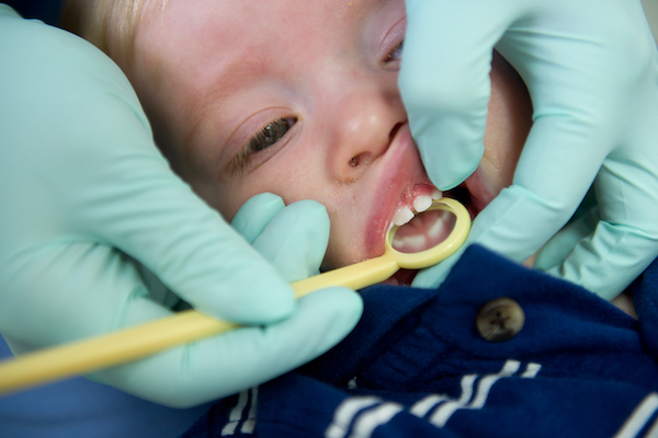 Primer plano de un bebé a quien le están pasando un hilo dental.