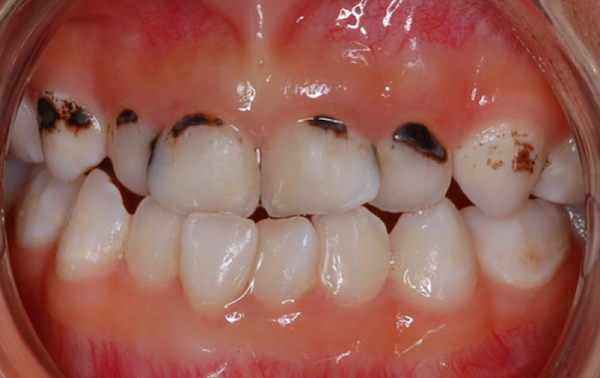 Closeup of teeth showing severe tooth decay.