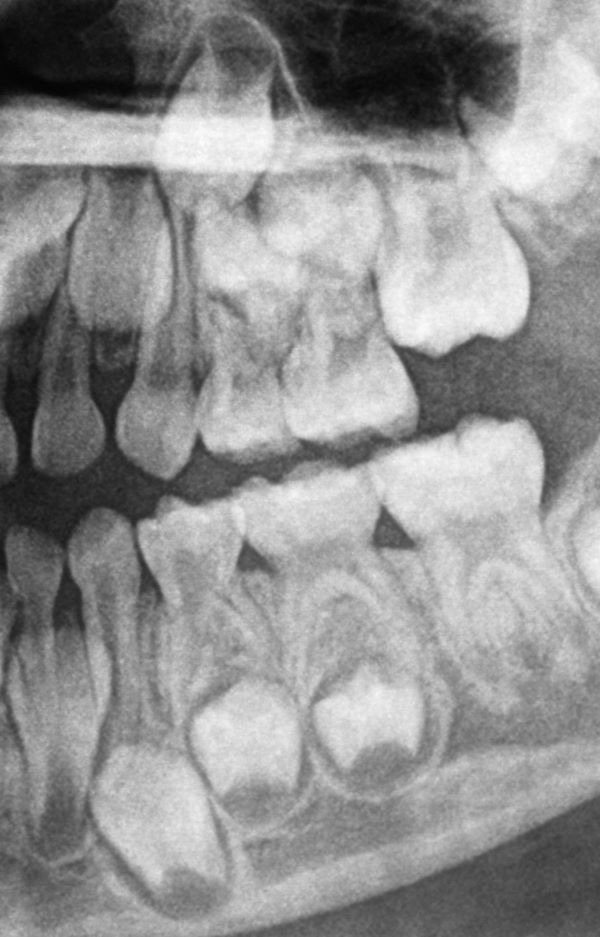 Radiografía de unos dientes de leche.