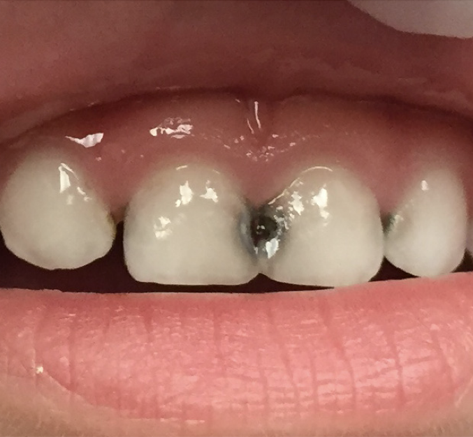 Teeth with SDF treatment.